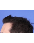 After Hair Transplant&nbsp;Front